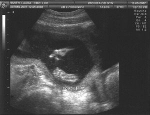 Sonogram 1 - Foot