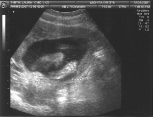 Sonogram 2 - Foot