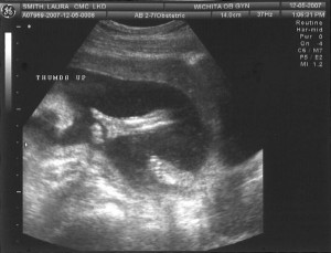 Sonogram 3 - Thumbs Up