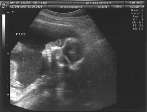 Sonogram 4 - Face
